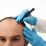 Greffe de cheveux en turquie : pourquoi ce choix séduit autant ?