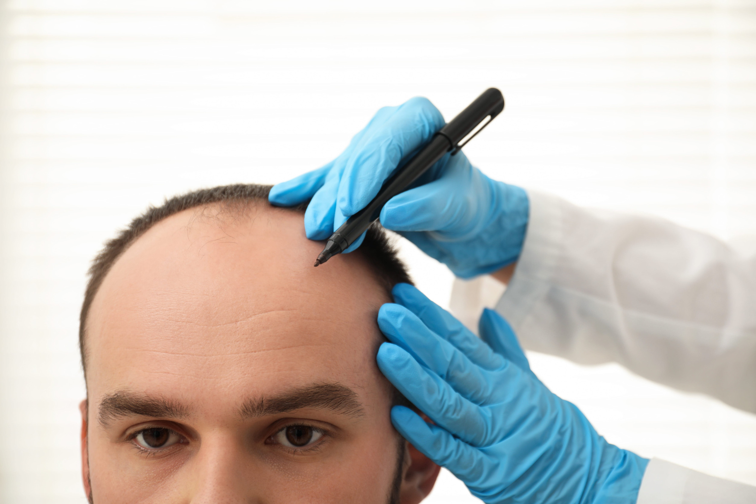 Greffe de cheveux en turquie : pourquoi ce choix séduit autant ?